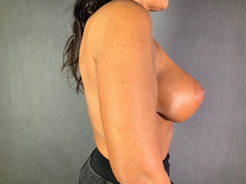 Breast Lift with Augmentation Before & After Gallery - Patient 166979395 - Image 6