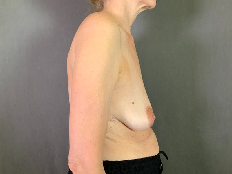 Breast Lift with Augmentation Before & After Gallery - Patient 166979404 - Image 5
