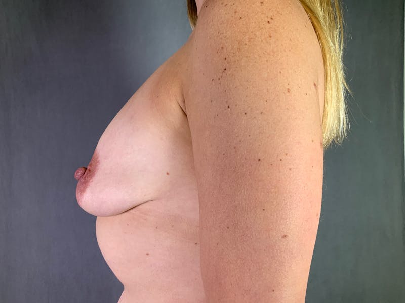Breast Lift with Augmentation Before & After Gallery - Patient 166979405 - Image 5