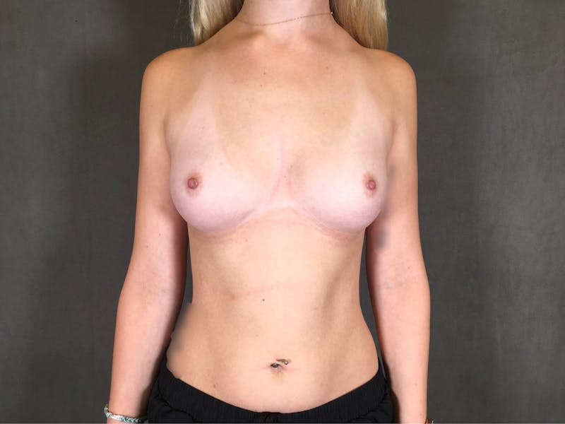 Breast Augmentation Before & After Gallery - Patient 166979468 - Image 1