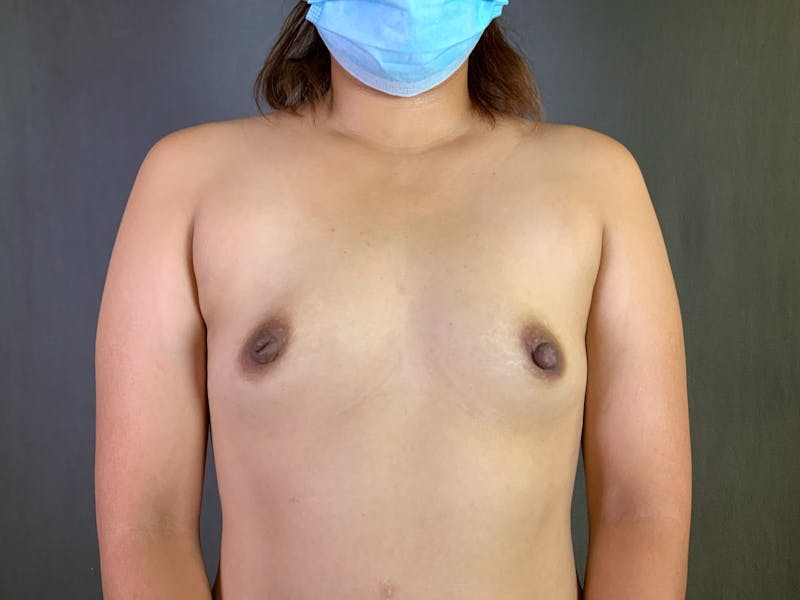 Breast Augmentation Before & After Gallery - Patient 166981037 - Image 1