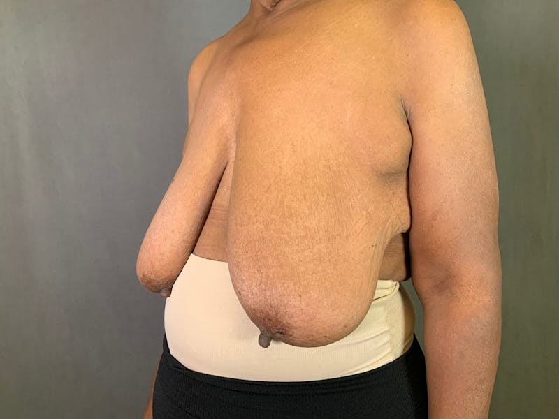 Breast Lift Before & After Gallery - Patient 167373910 - Image 1