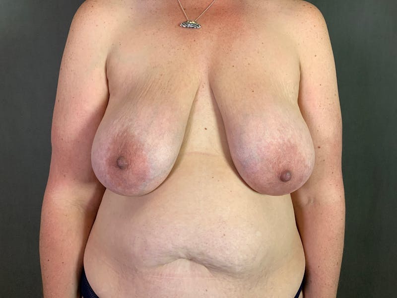 Breast Lift Before & After Gallery - Patient 167377825 - Image 1