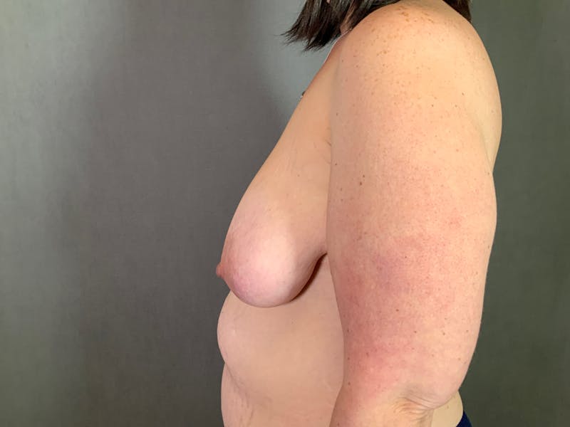 Breast Lift Before & After Gallery - Patient 167377825 - Image 5