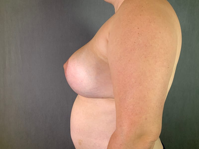 Breast Lift Before & After Gallery - Patient 167377133 - Image 6