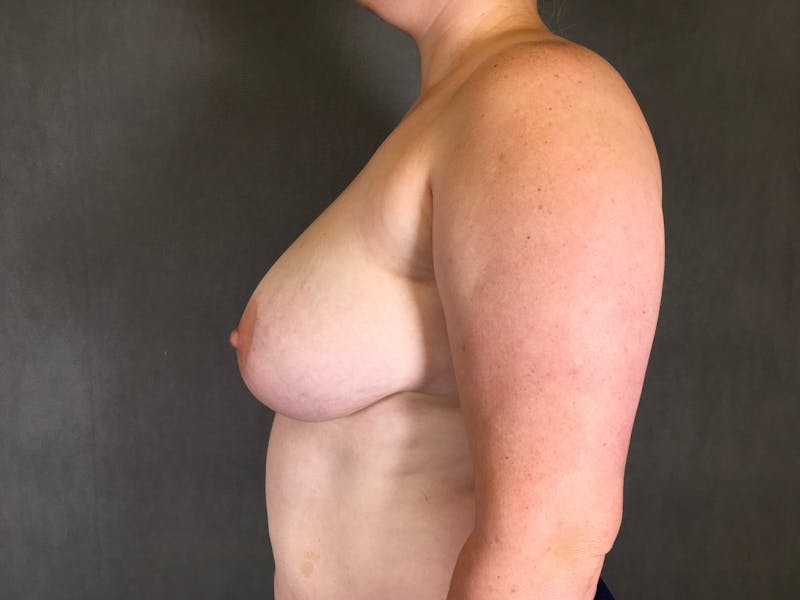 Breast Lift Before & After Gallery - Patient 167377133 - Image 5