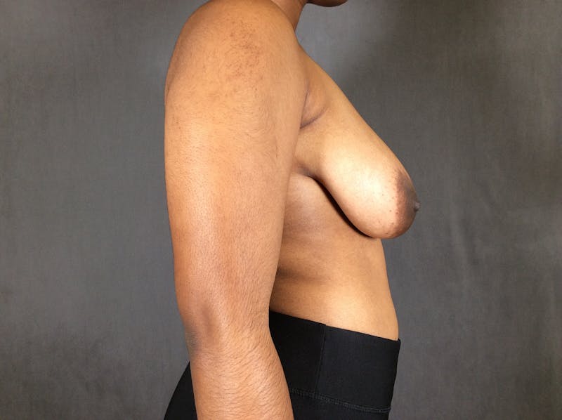 Breast Lift Before & After Gallery - Patient 167381157 - Image 5