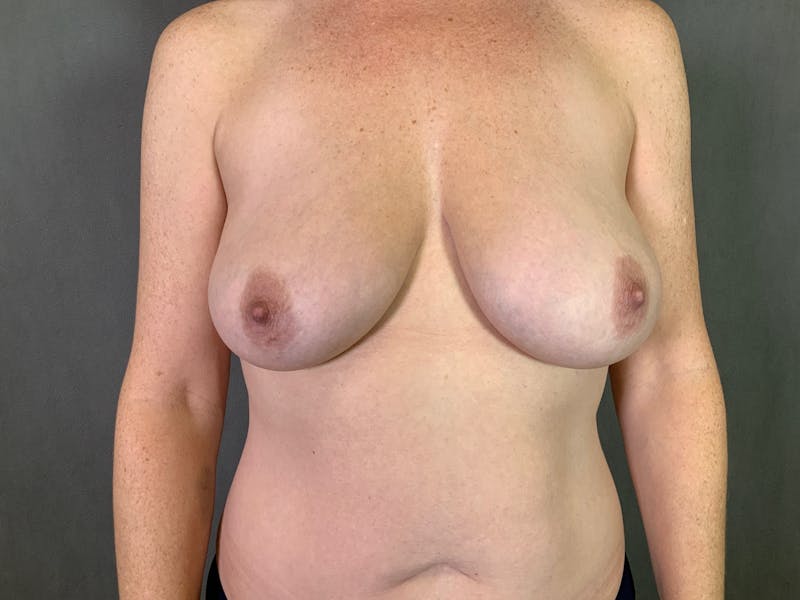 Breast Lift Before & After Gallery - Patient 167381269 - Image 1