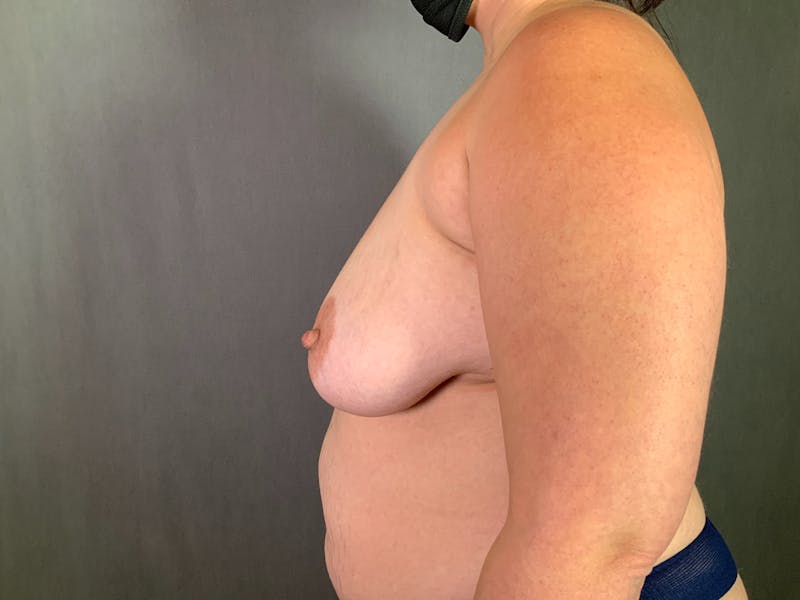 Breast Lift Before & After Gallery - Patient 167377775 - Image 5
