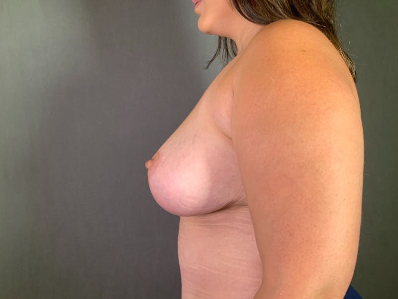 Breast Lift Before & After Gallery - Patient 167377775 - Image 6