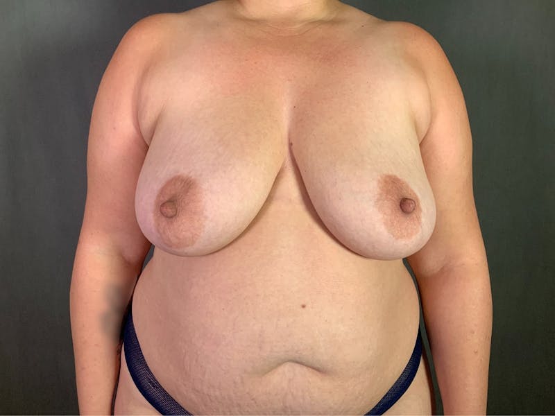 Breast Lift Before & After Gallery - Patient 167377775 - Image 1