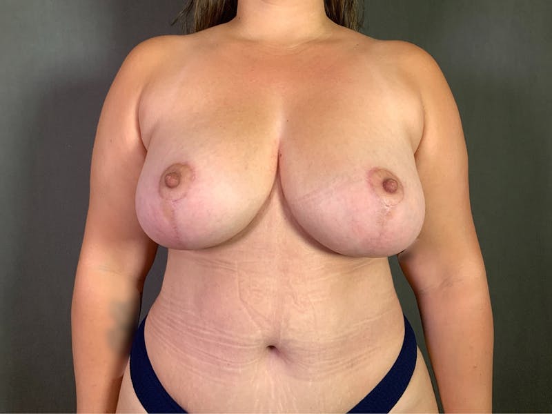 Breast Lift Before & After Gallery - Patient 167377775 - Image 2