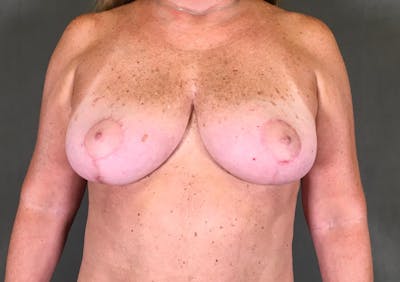 Breast Lift Before & After Gallery - Patient 167381002 - Image 2