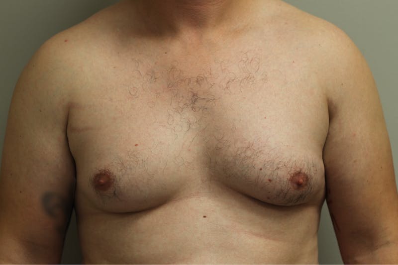 Gynecomastia Before & After Gallery - Patient 167384051 - Image 1