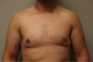 Gynecomastia Before & After Gallery - Patient 167384051 - Image 2