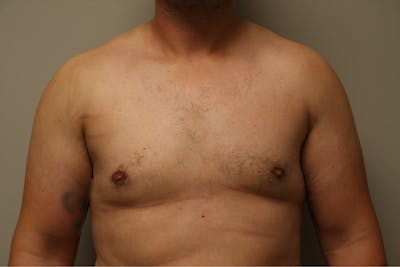 Gynecomastia Before & After Gallery - Patient 167384051 - Image 2