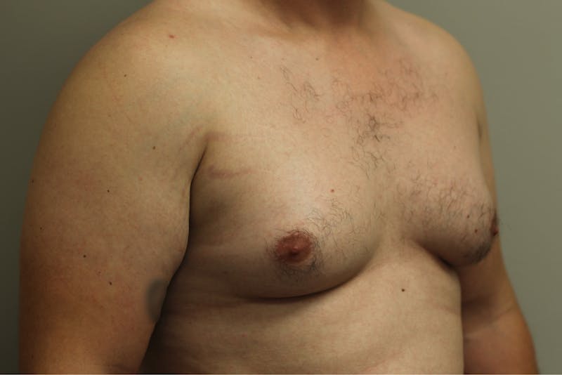 Gynecomastia Before & After Gallery - Patient 167384051 - Image 3