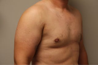 Gynecomastia Before & After Gallery - Patient 167384051 - Image 4