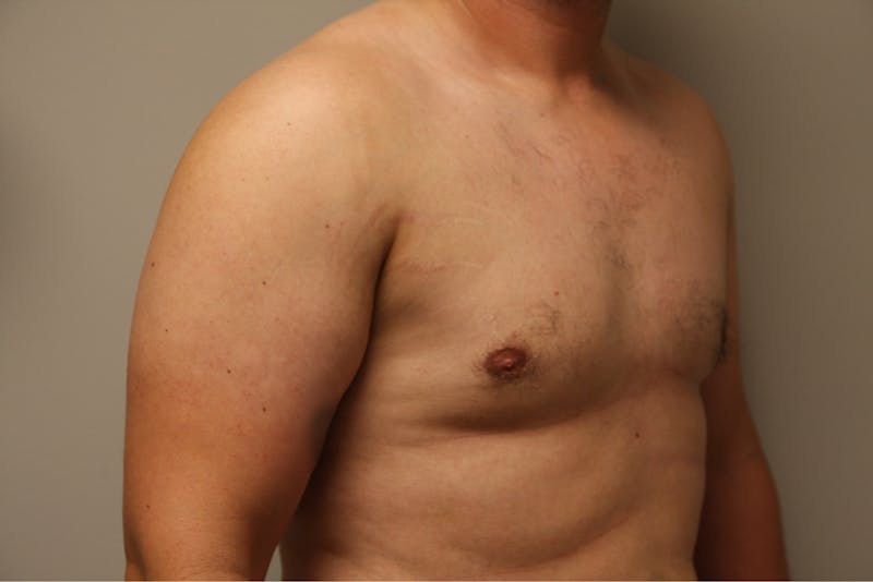 Gynecomastia Before & After Gallery - Patient 167384051 - Image 4