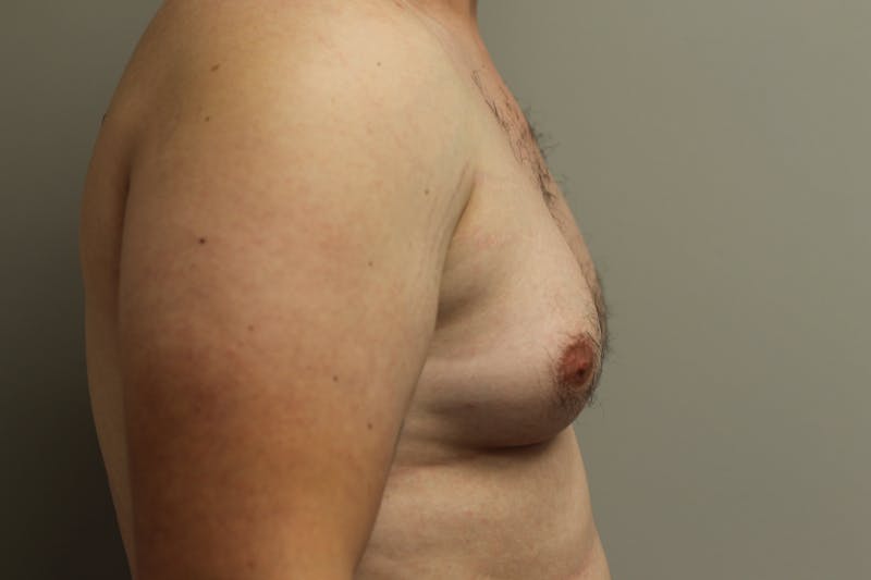 Gynecomastia Before & After Gallery - Patient 167384051 - Image 5
