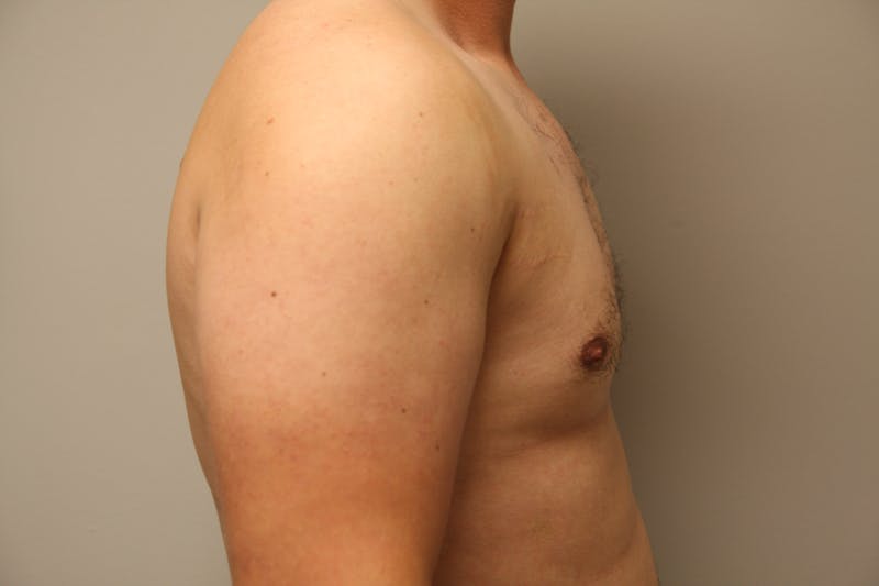Gynecomastia Before & After Gallery - Patient 167384051 - Image 6