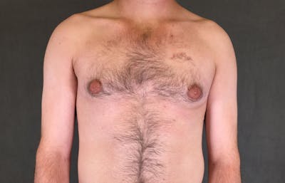 Gynecomastia Before & After Gallery - Patient 167385073 - Image 1