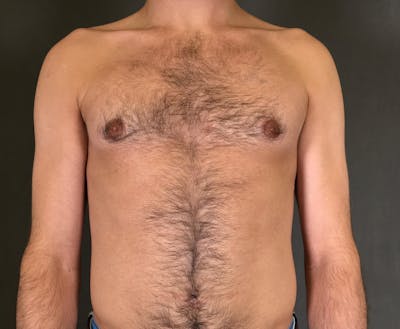 Gynecomastia Before & After Gallery - Patient 167385073 - Image 2