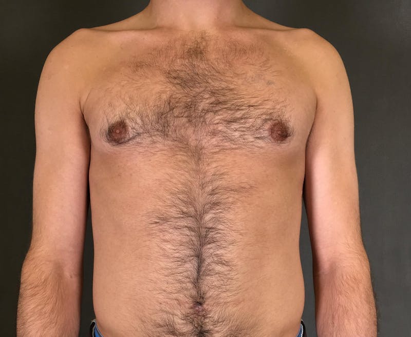 Gynecomastia Before & After Gallery - Patient 167385073 - Image 2