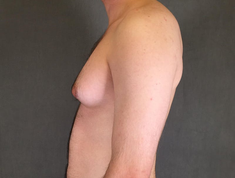 Gynecomastia Before & After Gallery - Patient 167385073 - Image 5