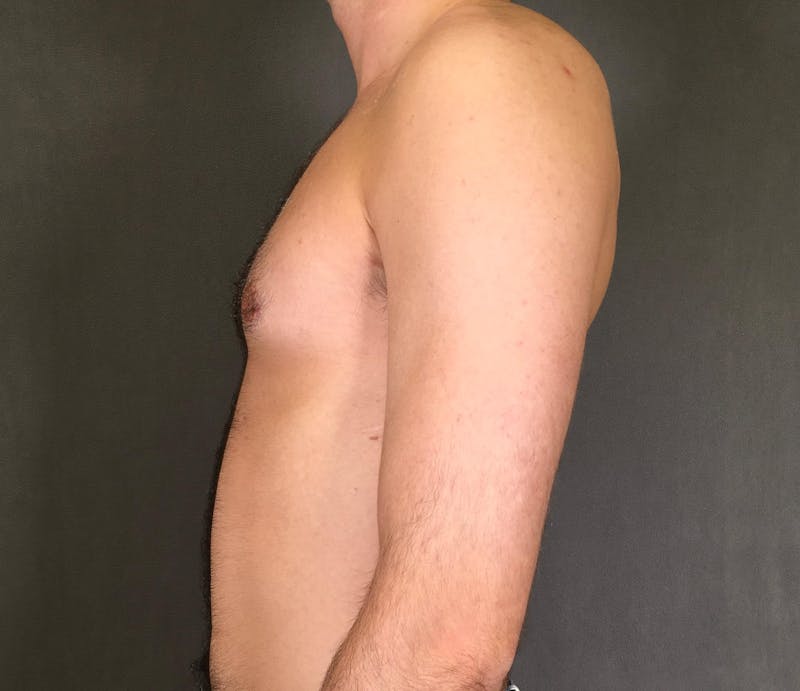 Gynecomastia Before & After Gallery - Patient 167385073 - Image 6