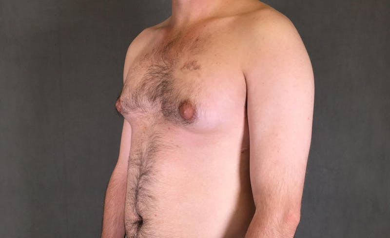 Gynecomastia Before & After Gallery - Patient 167385073 - Image 3
