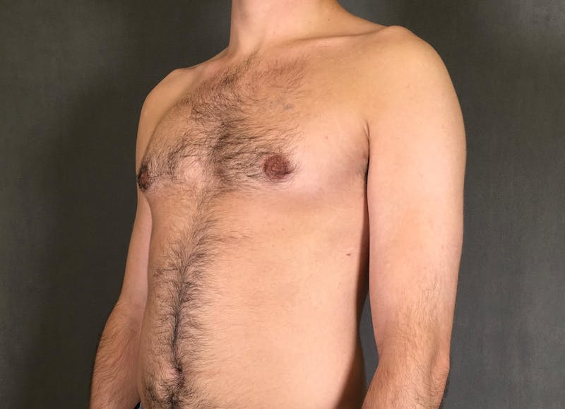 Gynecomastia Before & After Gallery - Patient 167385073 - Image 4