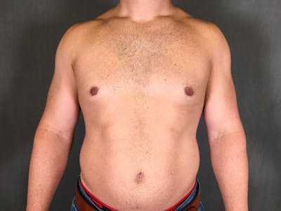 Gynecomastia Before & After Gallery - Patient 167385125 - Image 2