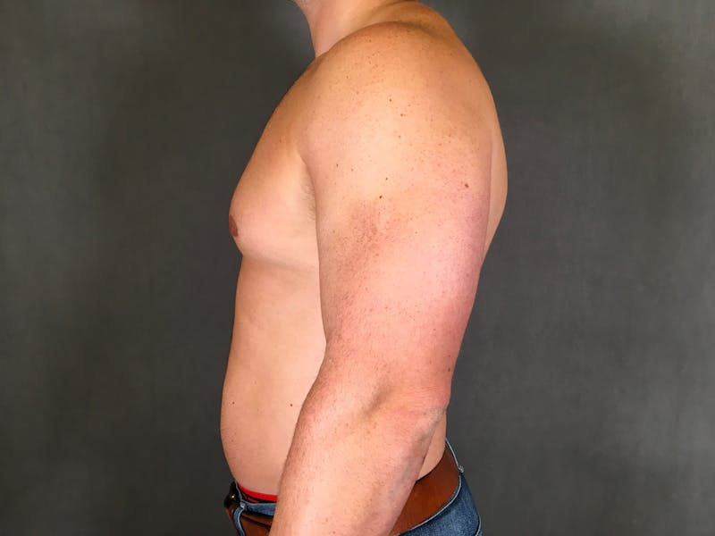 Gynecomastia Before & After Gallery - Patient 167385125 - Image 6