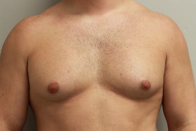 Gynecomastia Before & After Gallery - Patient 167385125 - Image 1