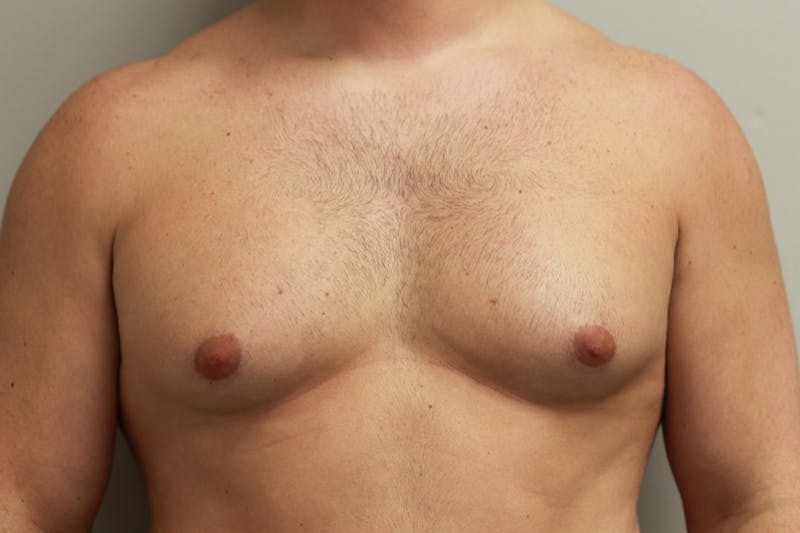 Gynecomastia Before & After Gallery - Patient 167385125 - Image 1
