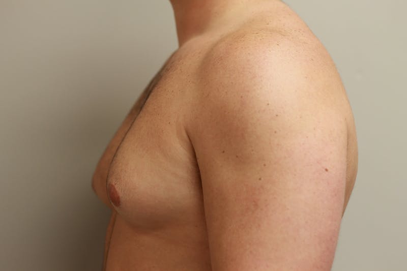 Gynecomastia Before & After Gallery - Patient 167385125 - Image 5