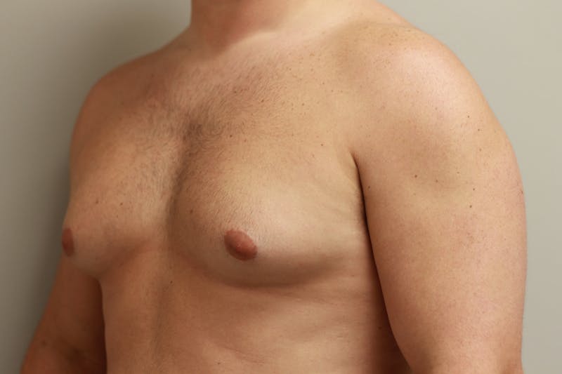 Gynecomastia Before & After Gallery - Patient 167385125 - Image 3