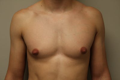 Gynecomastia Before & After Gallery - Patient 167385259 - Image 1