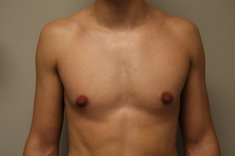 Gynecomastia Before & After Gallery - Patient 167385259 - Image 2
