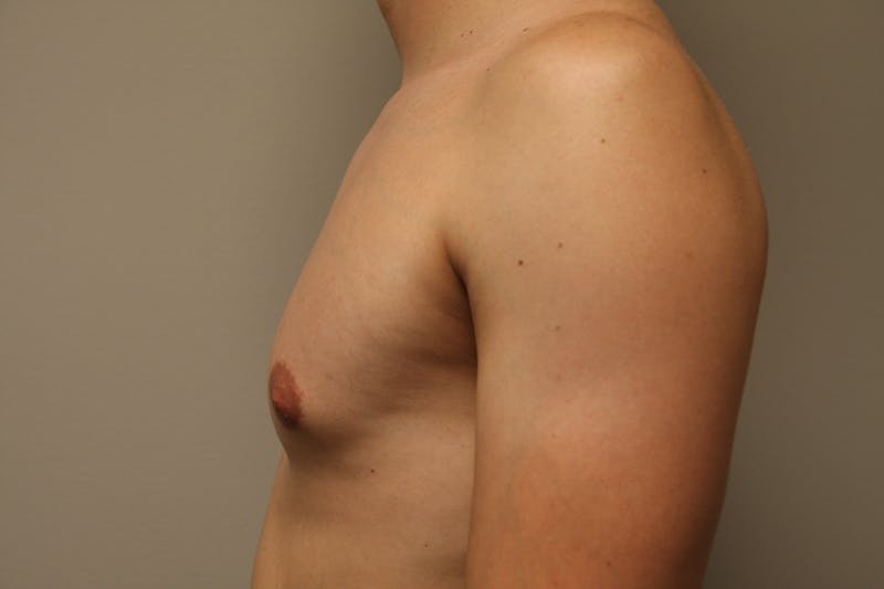 Gynecomastia Before & After Gallery - Patient 167385259 - Image 3