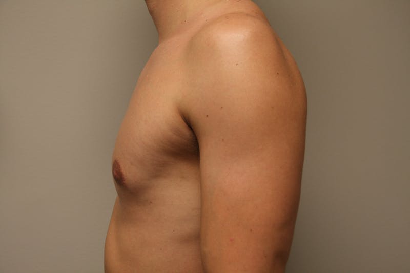 Gynecomastia Before & After Gallery - Patient 167385259 - Image 4