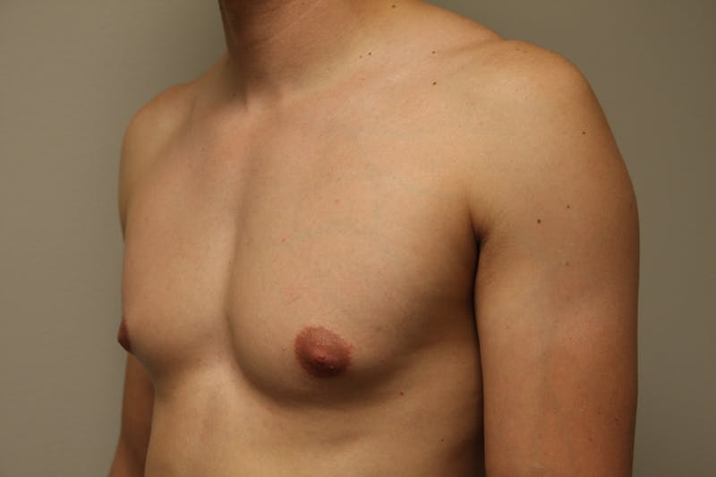 Gynecomastia Before & After Gallery - Patient 167385259 - Image 5