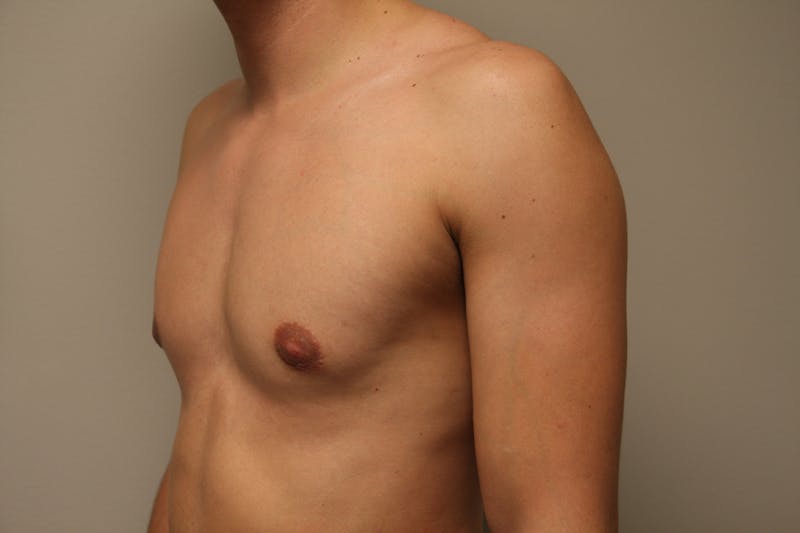 Gynecomastia Before & After Gallery - Patient 167385259 - Image 6