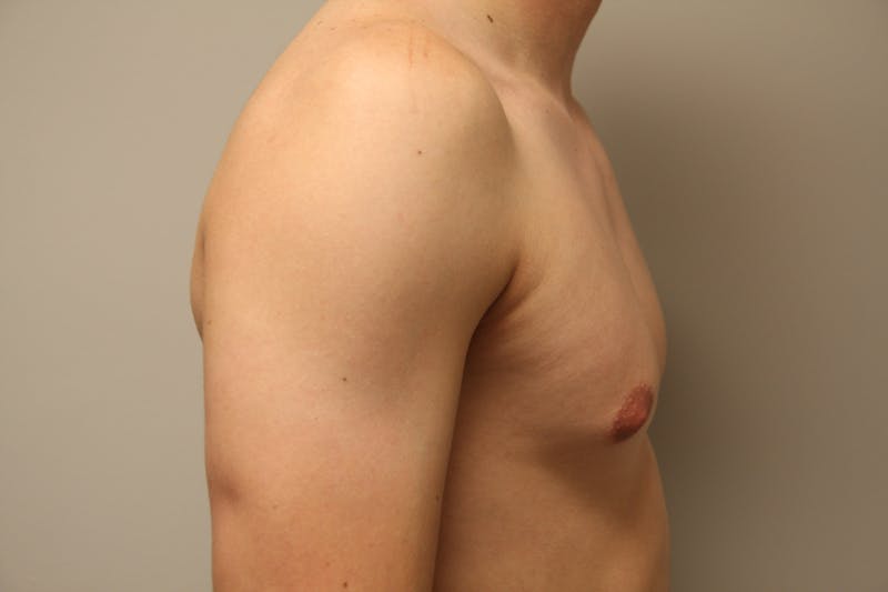 Gynecomastia Before & After Gallery - Patient 167385259 - Image 7