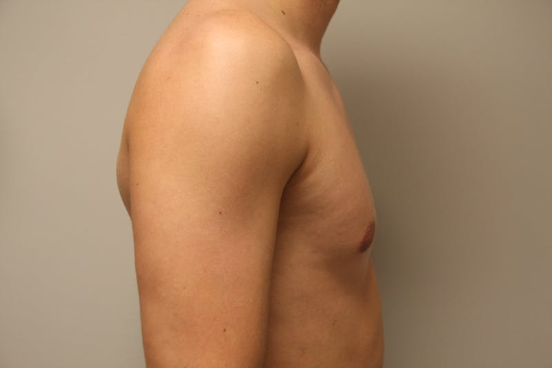 Gynecomastia Before & After Gallery - Patient 167385259 - Image 8