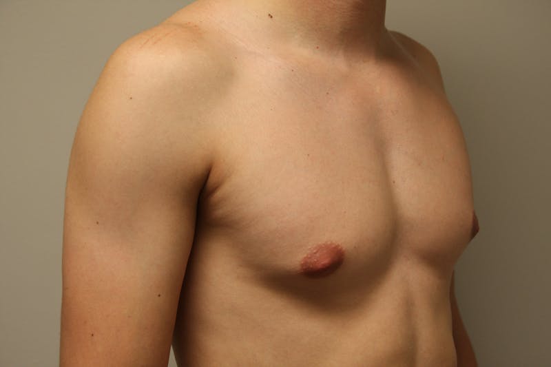Gynecomastia Before & After Gallery - Patient 167385259 - Image 9