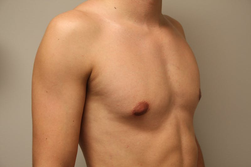 Gynecomastia Before & After Gallery - Patient 167385259 - Image 10