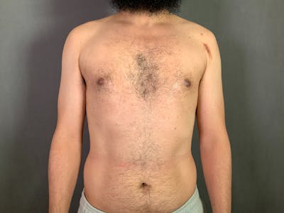 Gynecomastia Before & After Gallery - Patient 167388065 - Image 2