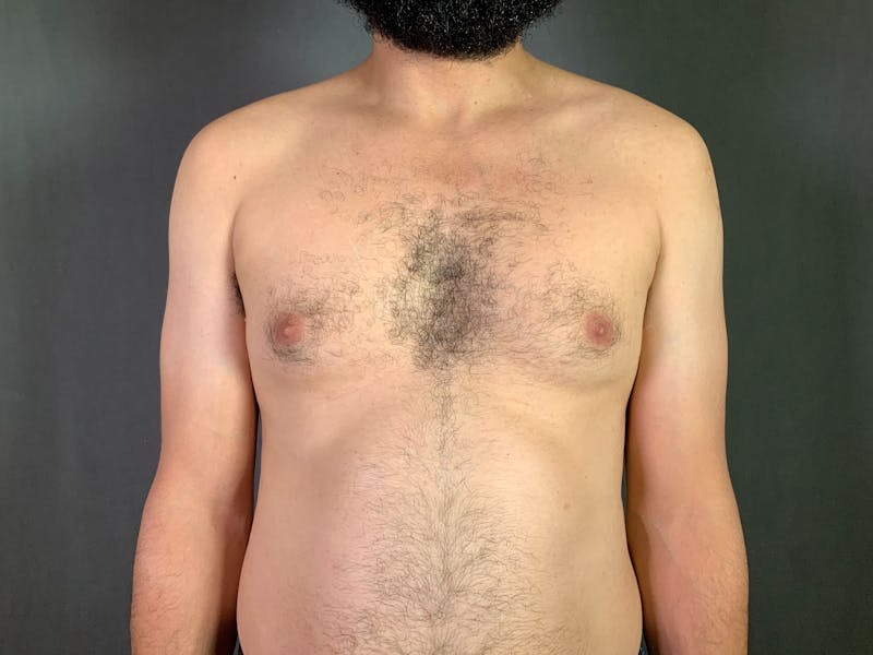 Gynecomastia Before & After Gallery - Patient 167388065 - Image 1